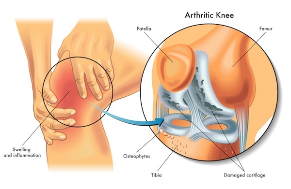 Inner Knee Pain Causes Treatment Prevention Complete Guide